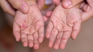 Καναδάς: Ένα παιδί πέθανε από ιλαρά, κάτι που συμβαίνει για πρώτη φορά από το 2013